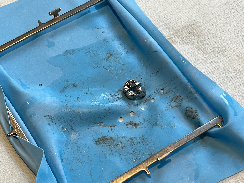 金属を除去後のラバーダムには、金属を除去する際にでた金属粉が無数に付着しています。前述のように飲み込まないように様々な工夫をしなければ、一度に多量の金属を摂取して、金属アレルギー症状が悪化してしまうことがあります。