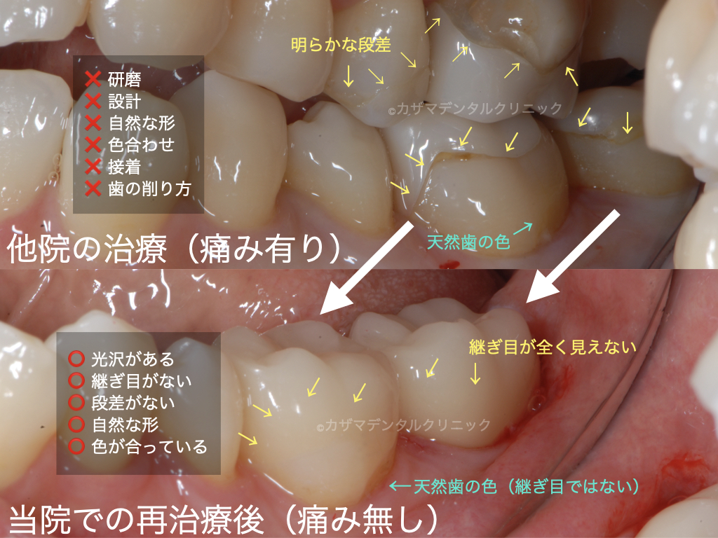 【誰にでも分かる正しいセラミック治療の見分け方：良くない奥歯のセラミック治療のやりなおし事例】下段がカザマデンタルクリニックでの治療。上段が他院での治療。非常に大きな段差さ隙間があり、歯と色が合っていない。また作られたセラミックの形も不自然で、天然歯の削り方もセラミックに適切でない。