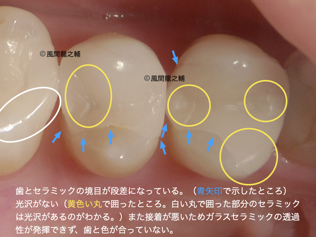 誰でも分かる「良くないセラミック治療」例：段差があるのは様々なトラブルの元になる。光沢がないのは研磨が足りていないから。研磨を十分にしないと、目に見えないヒビを除去できていなかったり、噛み合わせで抵抗が強くなる、歯の色がなじまないなど様々な問題の原因になる。