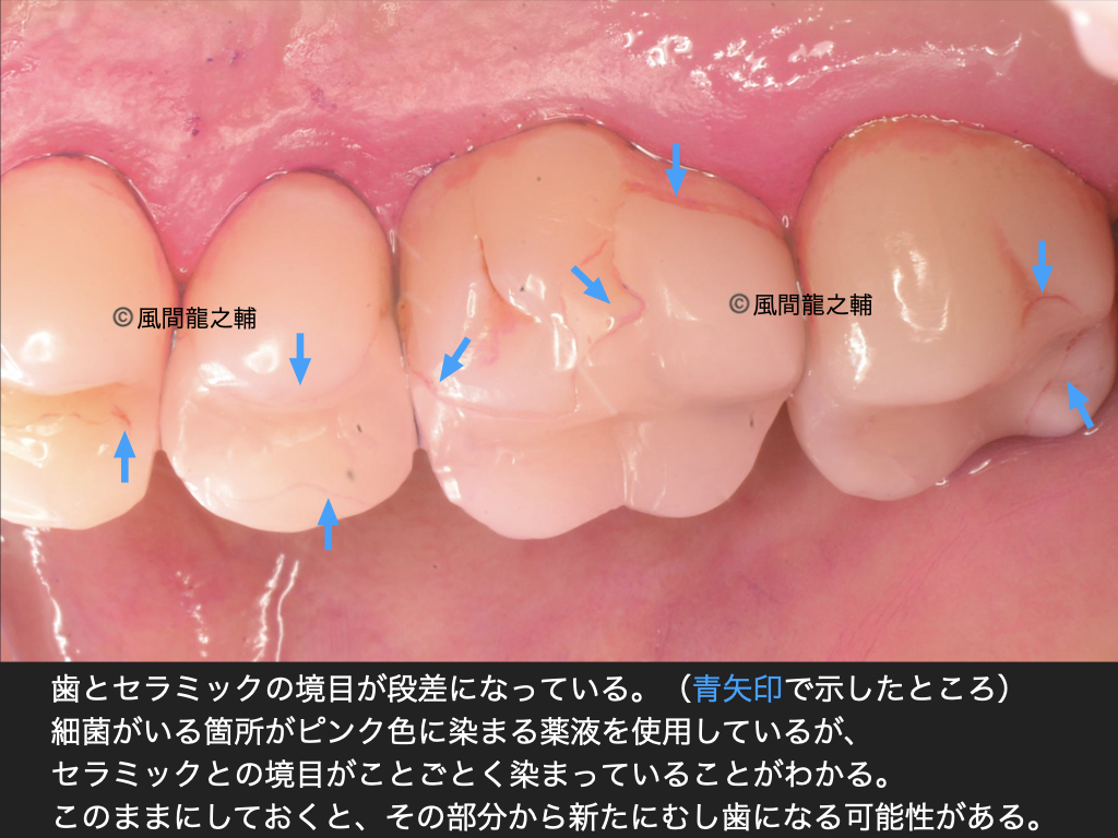 誰でも分かる「良くないセラミック治療」例：段差・境界に虫歯
