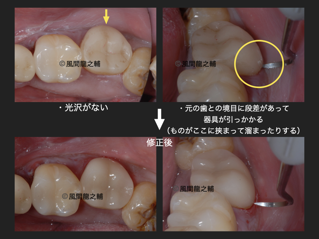 誰でも分かる「良くないセラミック治療」例：段差の下にフックが隠れているのに注目。