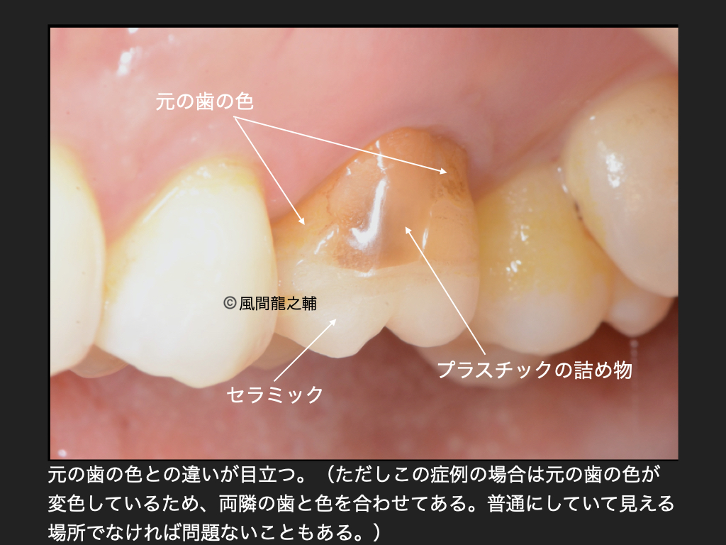 誰でも分かる「良くないセラミック治療」例：色の違い