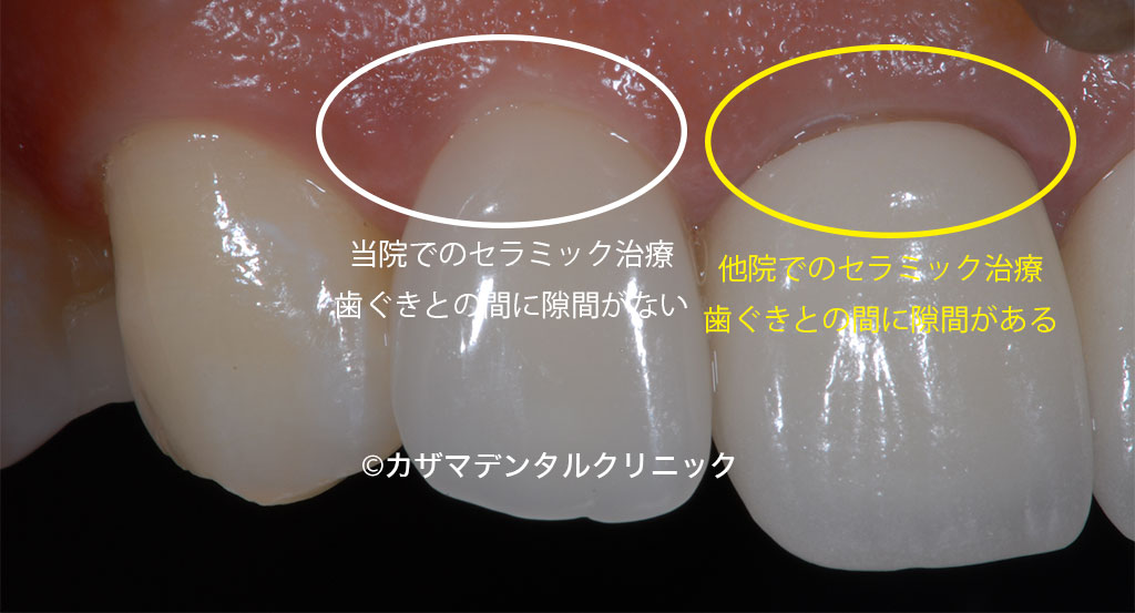 誰でも分かる「良くないセラミック治療」例：歯ぐきとセラミック歯の間に隙間があるとそこから虫歯になりやすい。早期の再治療をお勧めします。