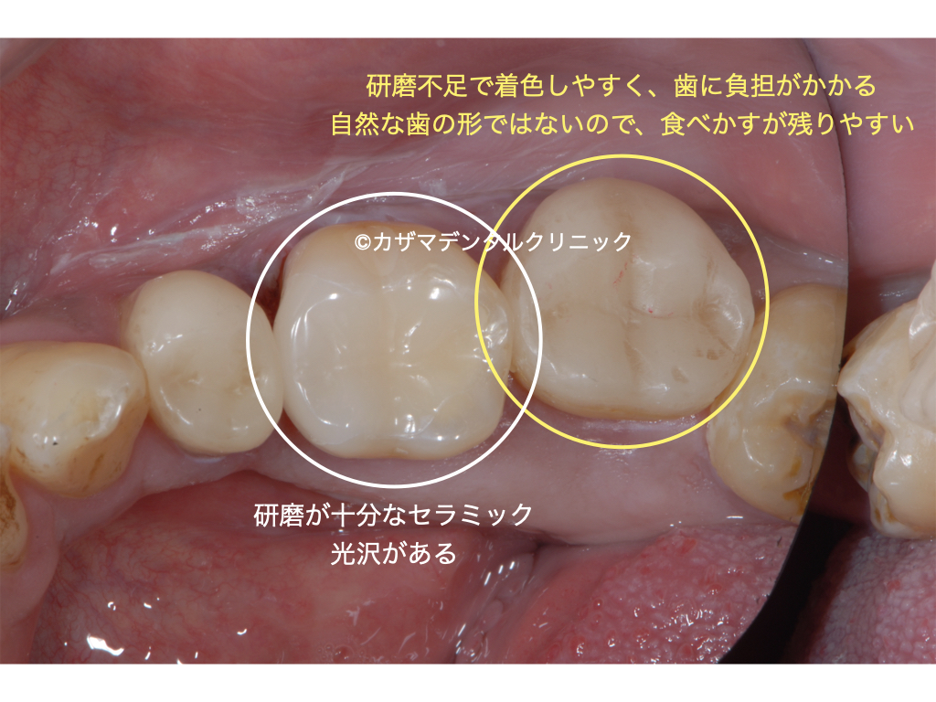 誰でも分かる「良くないセラミック治療」例：研磨不足。光沢がない。どの材料を用いるかにかかわらず、研磨はとても重要です。研磨は日本の歯科治療に於いてもっとも軽視されています。